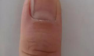 手指甲上有黑色竖纹 手指甲上有黑色竖纹